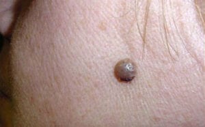 Födelsemärken/leverfläckar/nevus