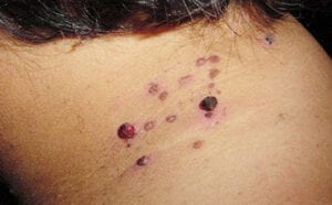 Hemangioma/smultronmärke 