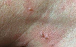 Fibrom Skintag