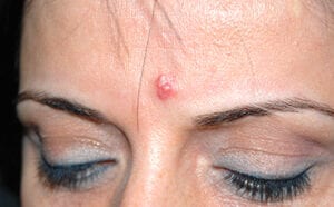 Fettknölar/lipom/talgkörtelhyperlasi