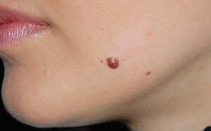 Hemangioma/smultronmärke 