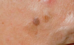 Pigmentfläckar/åldersfläckar/solfläckar/keratoser