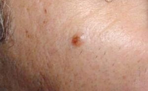 Seborrheic keratoses/åldersvårta/talgvårta/mjällvårta