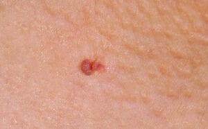 Fibrom Skintag
