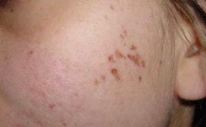 Pigmentfläckar/åldersfläckar/solfläckar/keratoser