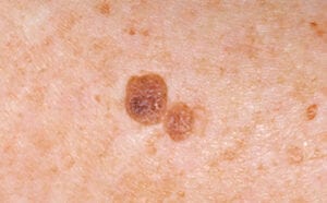 Seborrheic keratoses/åldersvårta/talgvårta/mjällvårta