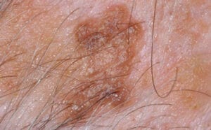 Seborrheic keratoses/åldersvårta/talgvårta/mjällvårta
