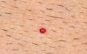 Hemangioma/smultronmärke 